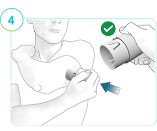 Illustrazione della Fase 4: Una persona che utilizza l’applicatore per inserire il CGM nel sito di applicazione preparato.